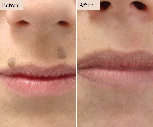 mole removal before after manhatttan nyc